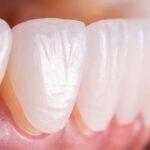 مراقبت از لمینیت دندان بعد از نصب: نکات کلیدی برای عمر بیشتر