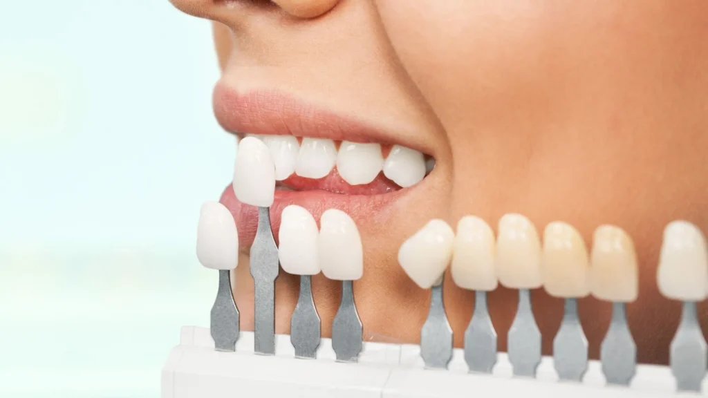لمینت دندان برای چه کسانی مناسب است؟