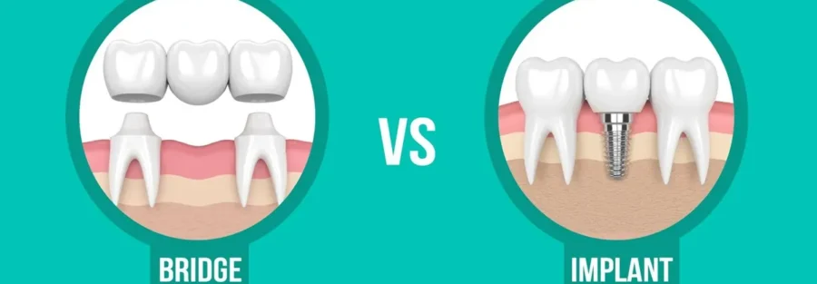 بریج بهتر است یا ایمپلنت؟