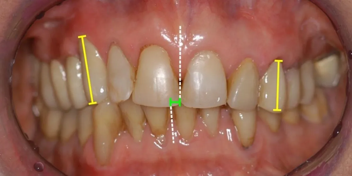 درمان دندان نیش با ارتودنسی