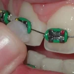 موم ارتودنسی چیست و چطور باید از آن استفاده کنیم؟