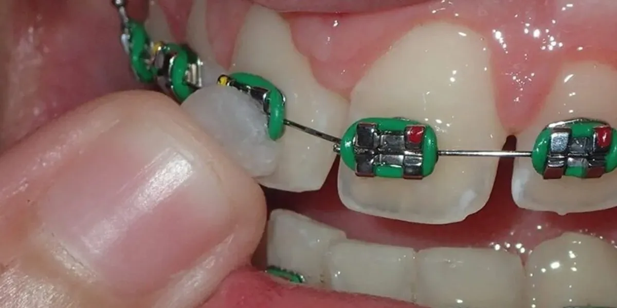 موم ارتودنسی