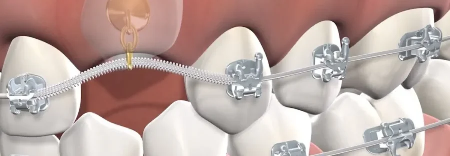 درمان دندان نیش با ارتودنسی