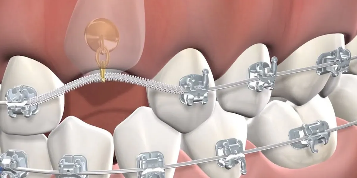 درمان دندان نیش با ارتودنسی