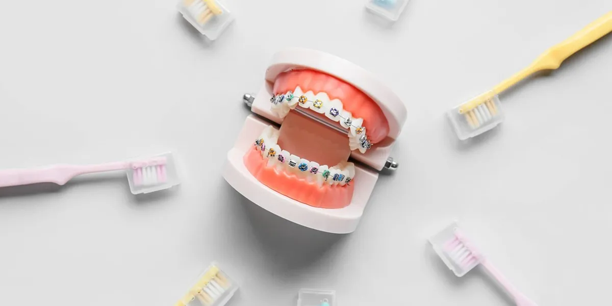 آفت دهان در زمان ارتودنسی