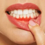 درمان فوری آبسه دندان و لثه در حین درمان ارتودنسی