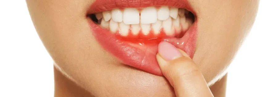 آبسه دندان و لثه در حین درمان ارتودنسی