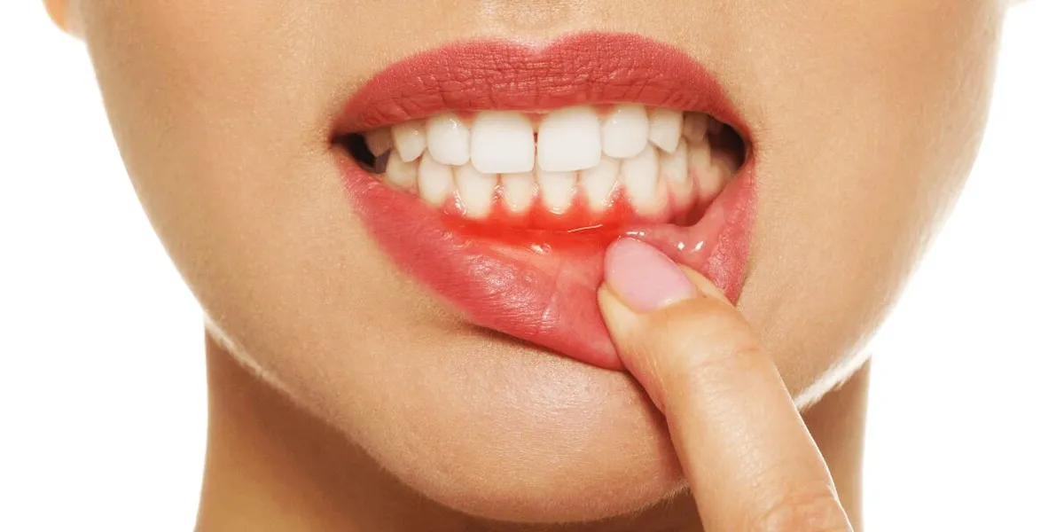 آبسه دندان و لثه در حین درمان ارتودنسی