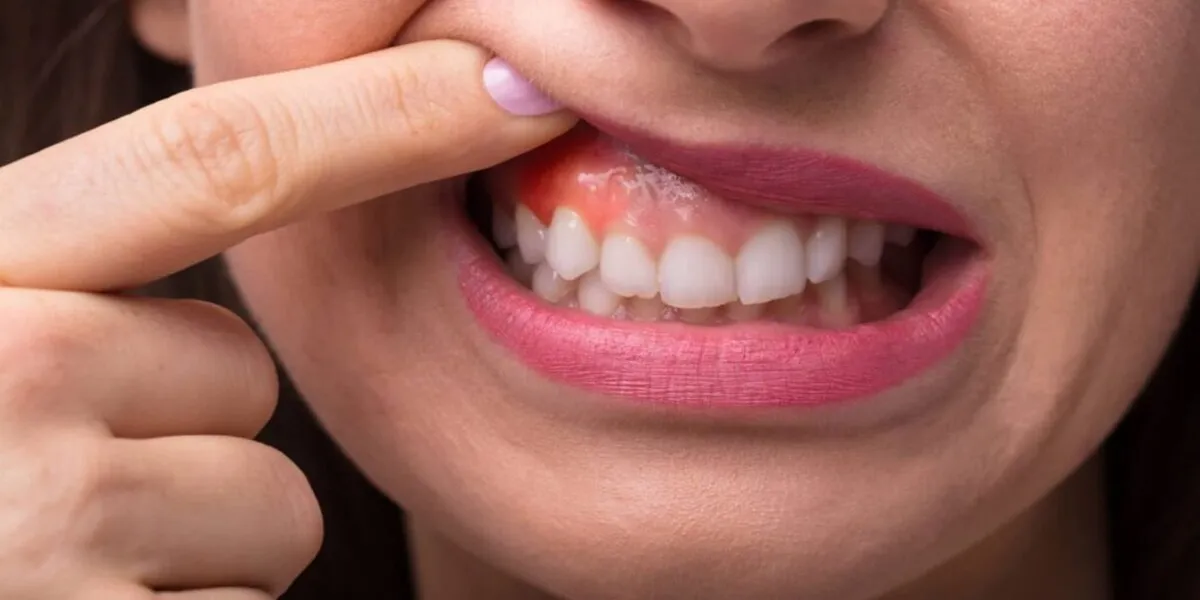 آبسه دندان و لثه در حین درمان ارتودنسی