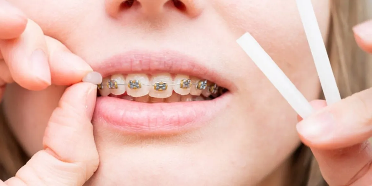 موم ارتودنسی