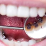 منظور از پستانک ارتودنسی چیست؟