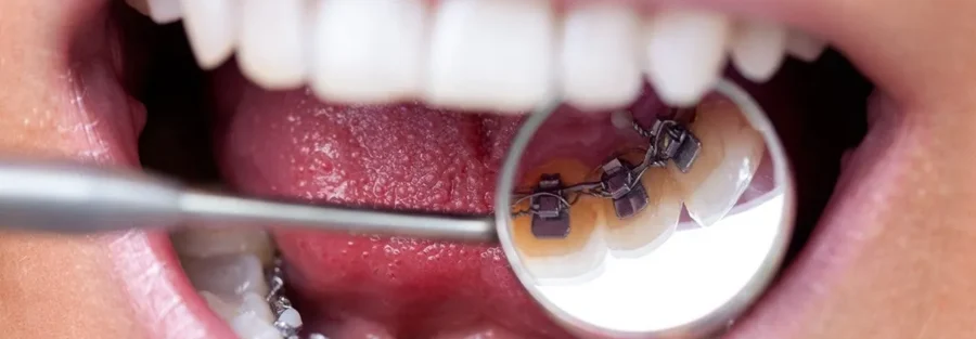 منظور از پستانک ارتودنسی چیست؟