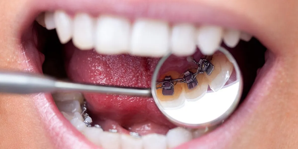 منظور از پستانک ارتودنسی چیست؟