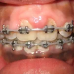 درمان التهاب لثه در حین ارتودنسی + نکات و ترفندهای سریع