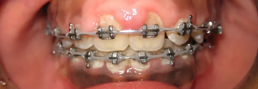 درمان التهاب لثه در حین ارتودنسی