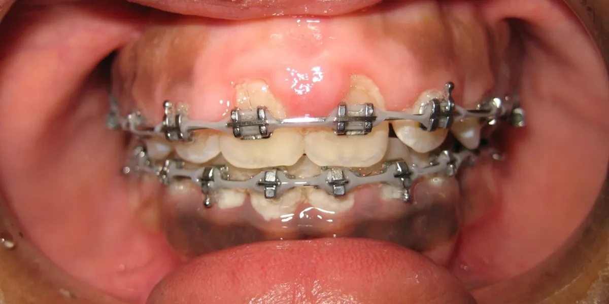 درمان التهاب لثه در حین ارتودنسی