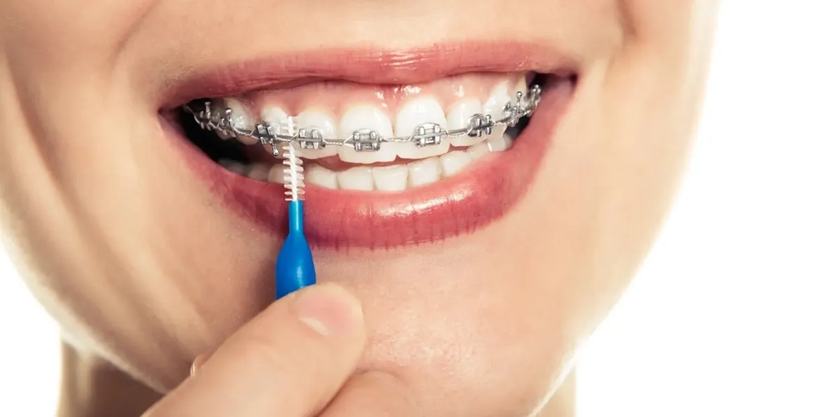 درمان التهاب لثه در حین ارتودنسی